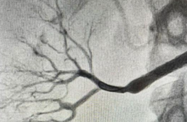 В Приморье спасли пациентку с редкой болезнью Ормонда