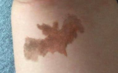 В приморской семье дети родились с родимыми пятнами в виде летучей мыши (фото)