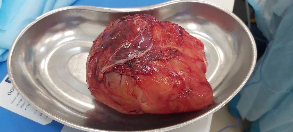 В Приморье врачи удалили юноше опухоль надпочечника весом почти килограмм
