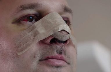 Житель Владивостока рассказал в телеэфире, как неудачно скорректировал нос